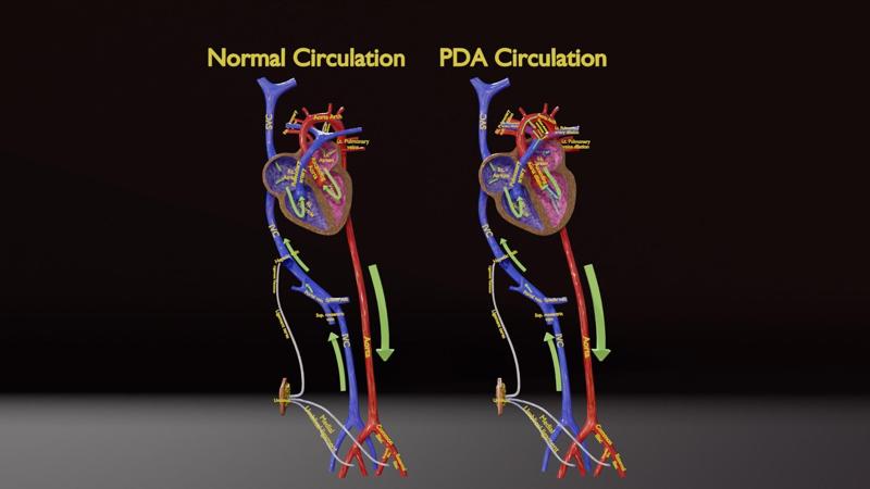 PDA Patent Ductus Arteriosus vs Normal blood circulation