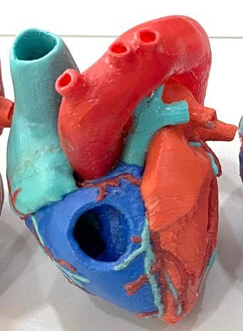 3D tetralogy of Fallot congenital heart disease