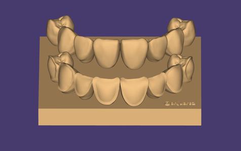 Dental Model With Preparations For Direct Veneer Practice