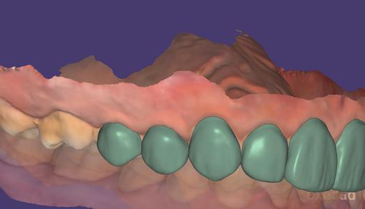 3d printed veneers  (no prep)