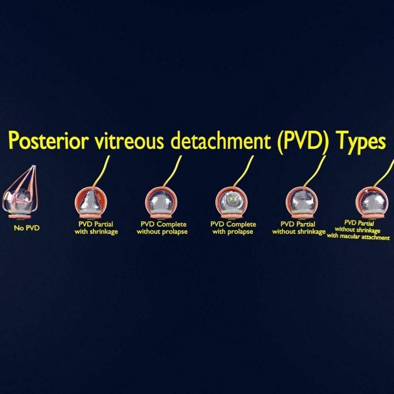 Posterior vitreous detachment types eye 3D model