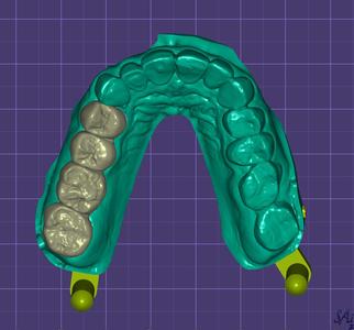 BRIDGE ZIRCONE AVEC MODEL DENTAL