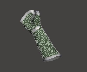 Custom-made splints, based on an arm scan