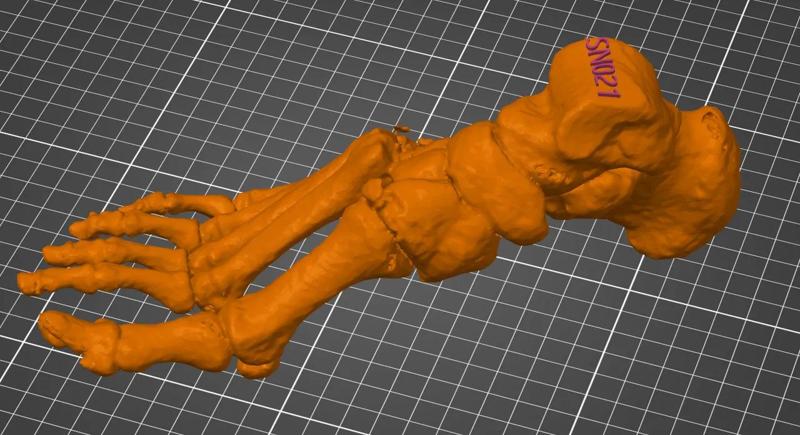 Human foot with Lisfranc joint displacement   