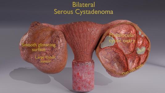 Ovary tumor benign non-cancerous serous cystadenoma
