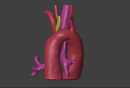 3D Model of Heart with Double Aortic Arch