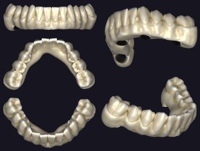 Full Lower Dental Hybrid Design
