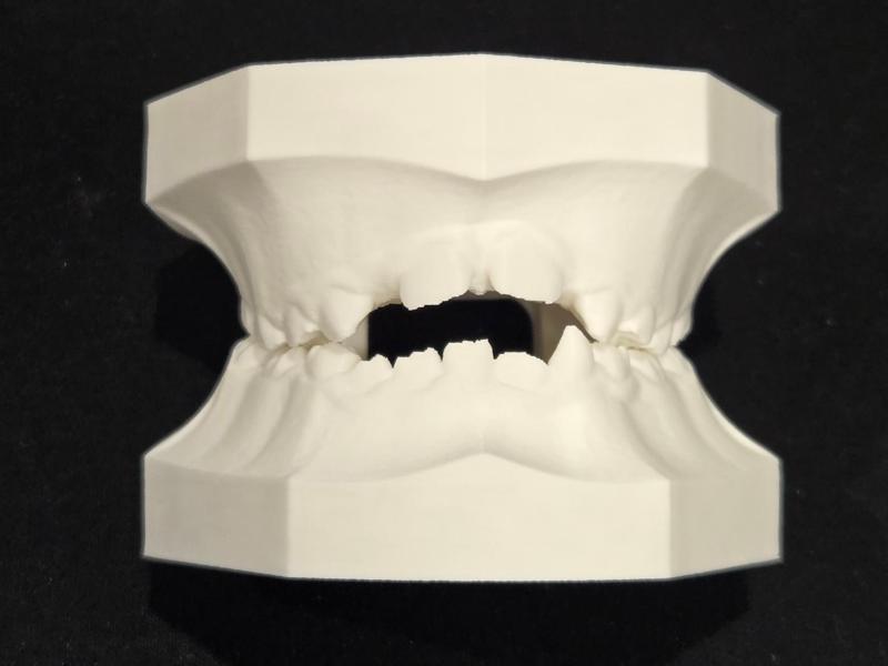 Pediatric Dental Typodont—Mixed Dentition Openbite