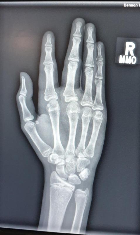 xray lithophane