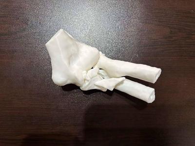 Complex Elbow Fracture-Dislocation