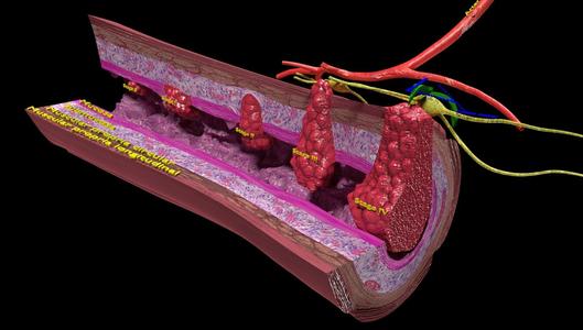 3D Colon cancer staging detail labelled