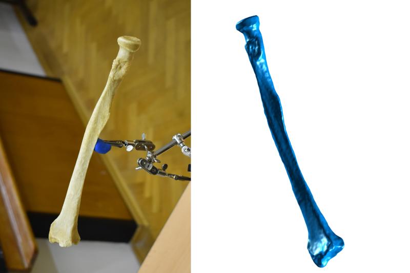 Forearm Bone Scan - Radius