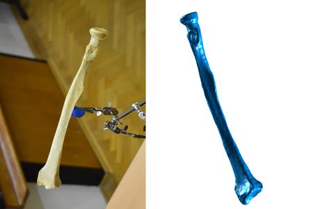 Forearm Bone Scan - Radius