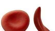 Sickle Cell proteins globin 