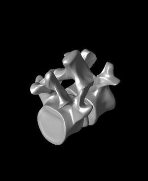 Spondy grade 1 bennett models.stl