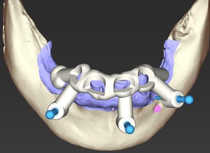 SURGICAL GUIDES STACKED IMPLANTS FOR LOWER FULL ARCH