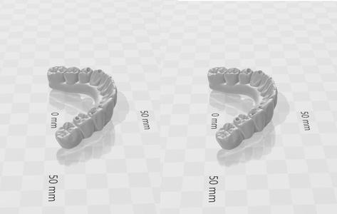 Lower Implant-Supported Protocol - 3D Model