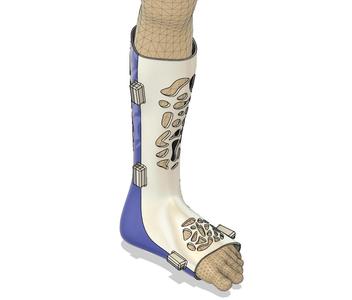 AFO/Ankle splint