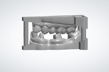 10 DENTAL STUDY MODELS - REAL PATIENTS, UPPER AND LOWER 3D MODELS WITH ADDITIONAL DIES