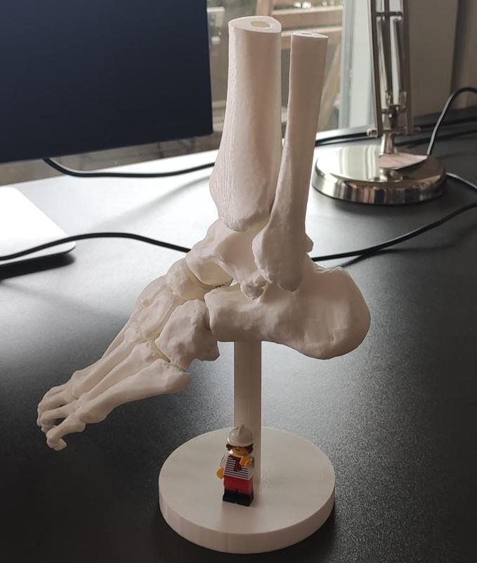 Foot fracture model with magnets