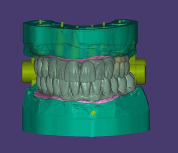 Complete All-on-6 Maxillary and Mandibular 3D Model