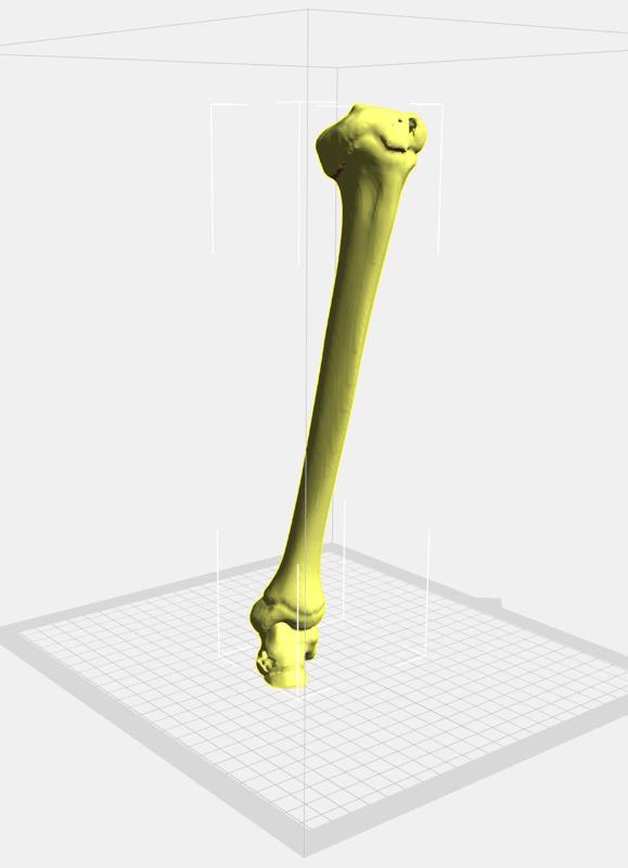 Adolescent Tibia Vara - Detailed Orthopedic Educational Tool