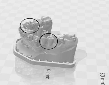 3D Model of Arches on Implants - 8 Elements (Upper and Lower)