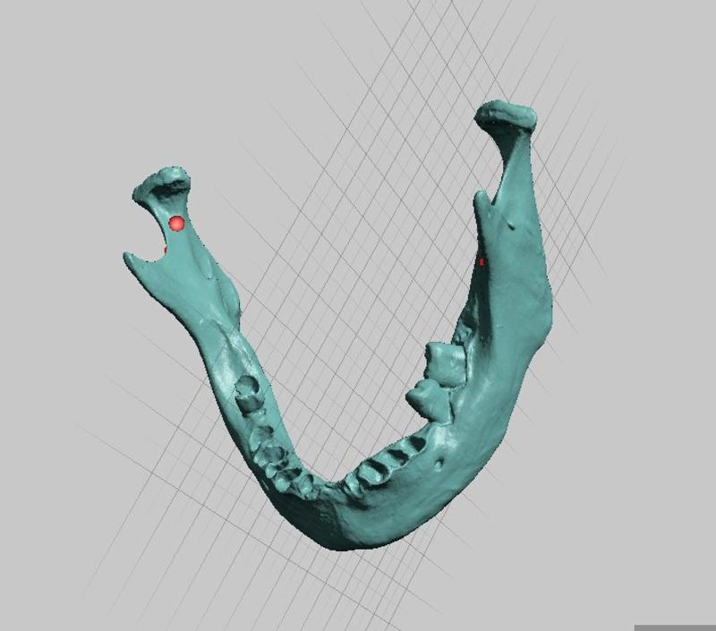 Human Mandible (Jaw) Bone Scan, Asian Ancestry, Female Sex