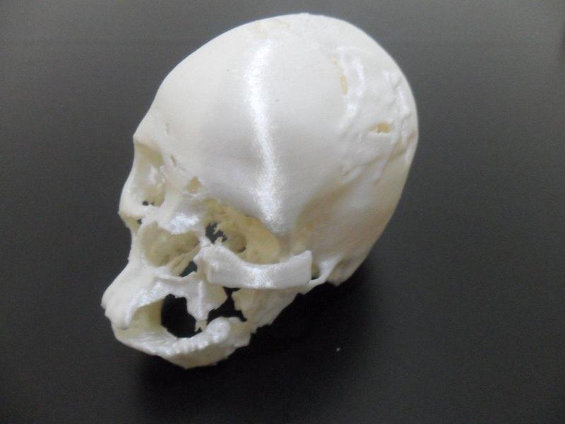 Post surgery traumatized skull