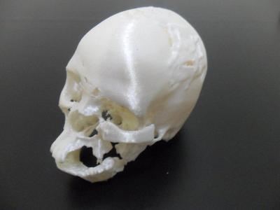 Post surgery traumatized skull
