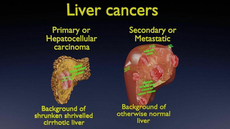 Liver cancer HCC vs Metastatic 3D model