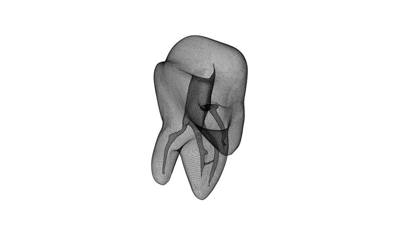 endo tooth