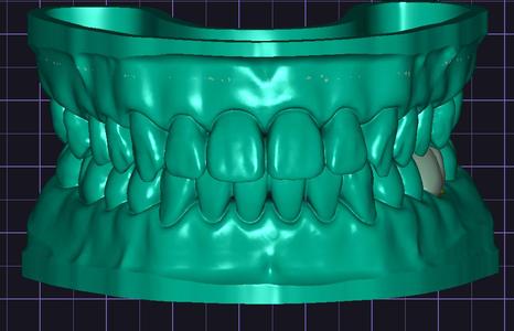 Dental Models and Dental Crown