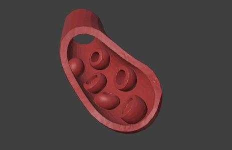 3D Model of Artery with Atherosclerosis