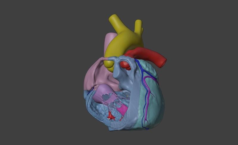 3D Model of Heart with Tetralogy of Fallot